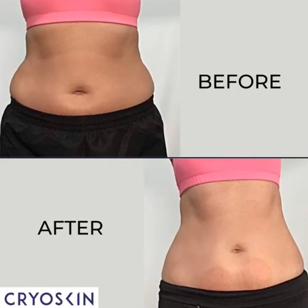 CryoSlimming Fat Reduction vs CoolSculpting: Which is Better for You?